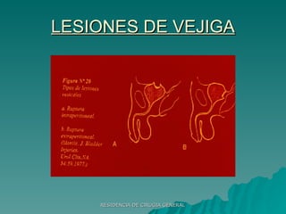 LESIONES DE VEJIGA 