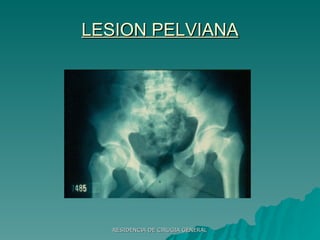LESION PELVIANA 