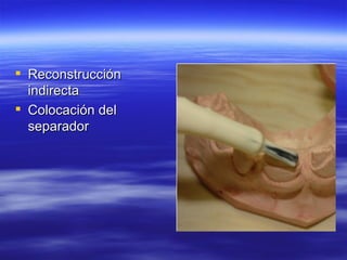 Reconstrucción indirecta Colocación del separador  