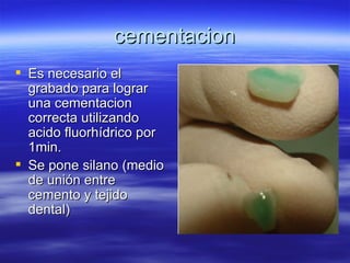 cementacion Es necesario el grabado para lograr una cementacion correcta utilizando acido fluorhídrico por 1min. Se pone silano (medio de unión entre cemento y tejido dental) 