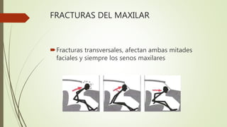 FRACTURAS DEL MAXILAR
Fracturas transversales, afectan ambas mitades
faciales y siempre los senos maxilares
 