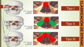 Tipo I
Tipo II
Tipo III
CLASIFICACIÓNDESTRANC
 