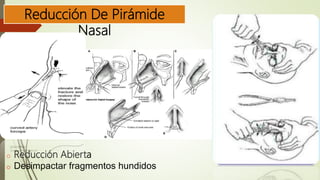 Reducción De Pirámide
Nasal
o Reducción Abierta
o Desimpactar fragmentos hundidos
 