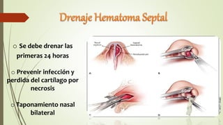 o Se debe drenar las
primeras 24 horas
o Prevenir infección y
perdida del cartílago por
necrosis
o Taponamiento nasal
bilateral
 