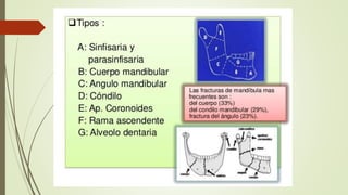 Traumatismo facial- final