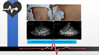 Imagen del cuadrante superior derecho (fosa hepatorrenal)
 