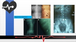 Rayos X de Abdomen:
 