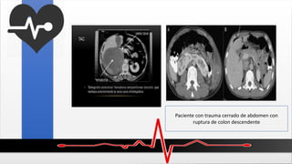 Paciente con trauma cerrado de abdomen con
ruptura de colon descendente
 