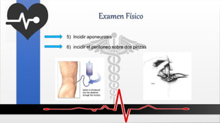 Examen Físico
5) Incidir aponeurosis
6) incidir el peritoneo sobre dos pinzas
 