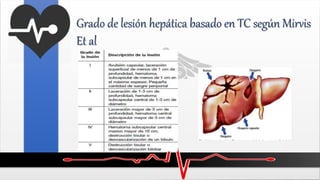 Grado de lesión hepática basado en TC según Mirvis
Et al
 
