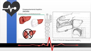 Empaquetamiento hepático
(PACKING)
 