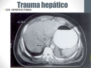 Trauma hepático
• SIN HEMOPERITONEO
 