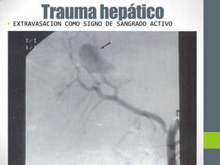 Trauma hepático
• EXTRAVASACION COMO SIGNO DE SANGRADO ACTIVO
 