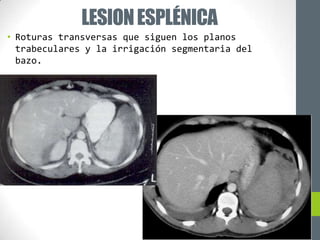 LESION ESPLÉNICA
• Roturas transversas que siguen los planos
  trabeculares y la irrigación segmentaria del
  bazo.
 