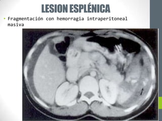 LESION ESPLÉNICA
• Fragmentación con hemorragia intraperitoneal
  masiva
 