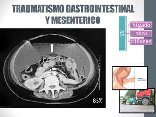 TRAUMATISMO GASTROINTESTINAL
       Y MESENTERICO       hígado




                         5%
                               bazo
                              riñones




                   85%
 