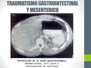 TRAUMATISMO GASTROINTESTINAL
       Y MESENTERICO




    Perforación de la unión gastroesofágica
          Hemoperitoneo, aire libre y
           extravasación de contraste
 