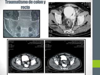 Traumatismo de colon y
        recto
 