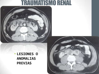 TRAUMATISMO RENAL




• LESIONES O
  ANOMALIAS
  PREVIAS
 