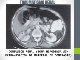 TRAUMATISMO RENAL




 • CONTUSION RENAL (ZONA HIPODENSA SIN
EXTRAVASACION DE MATERIAL DE CONTRASTE)
 