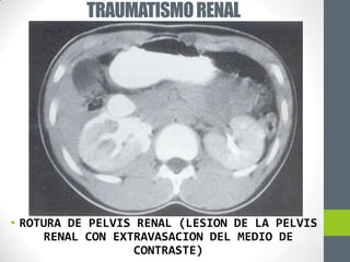 TRAUMATISMO RENAL




• ROTURA DE PELVIS RENAL (LESION DE LA PELVIS
     RENAL CON EXTRAVASACION DEL MEDIO DE
                  CONTRASTE)
 