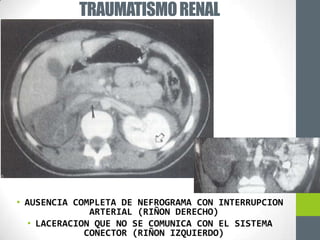 TRAUMATISMO RENAL




• AUSENCIA COMPLETA DE NEFROGRAMA CON INTERRUPCION
               ARTERIAL (RIÑON DERECHO)
   • LACERACION QUE NO SE COMUNICA CON EL SISTEMA
              CONECTOR (RIÑON IZQUIERDO)
 