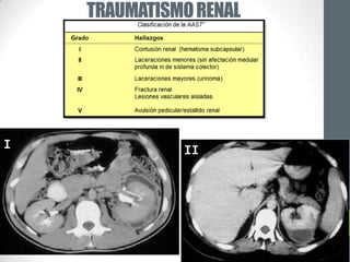 TRAUMATISMO RENAL




I             II
 
