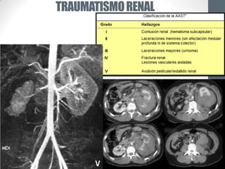 TRAUMATISMO RENAL




      V
 