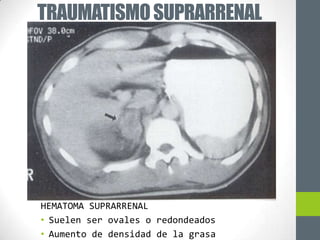 TRAUMATISMO SUPRARRENAL




HEMATOMA SUPRARRENAL
• Suelen ser ovales o redondeados
• Aumento de densidad de la grasa
 
