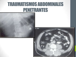TRAUMATISMOS ABDOMINALES
      PENETRANTES
 