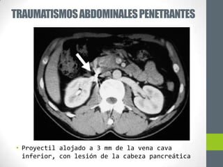 TRAUMATISMOS ABDOMINALES PENETRANTES




• Proyectil alojado a 3 mm de la vena cava
  inferior, con lesión de la cabeza pancreática
 
