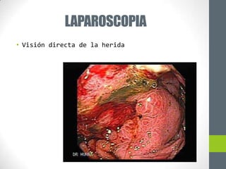 LAPAROSCOPIA
• Visión directa de la herida
 