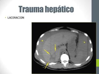 Trauma hepático
• LACERACION
 