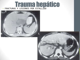 Trauma hepático
• FRACTURAS Y LESIONES POR ESTALLIDO
 