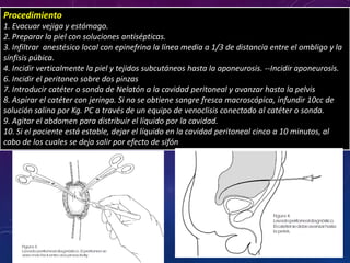 Procedimiento
1. Evacuar vejiga y estómago.
2. Preparar la piel con soluciones antisépticas.
3. Infiltrar anestésico local con epinefrina la línea media a 1/3 de distancia entre el ombligo y la
sínfisis púbica.
4. Incidir verticalmente la piel y tejidos subcutáneos hasta la aponeurosis. --Incidir aponeurosis.
6. Incidir el peritoneo sobre dos pinzas
7. Introducir catéter o sonda de Nelatón a la cavidad peritoneal y avanzar hasta la pelvis
8. Aspirar el catéter con jeringa. Si no se obtiene sangre fresca macroscópica, infundir 10cc de
solución salina por Kg. PC a través de un equipo de venoclisis conectado al catéter o sonda.
9. Agitar el abdomen para distribuir el líquido por la cavidad.
10. Si el paciente está estable, dejar el líquido en la cavidad peritoneal cinco a 10 minutos, al
cabo de los cuales se deja salir por efecto de sifón
 