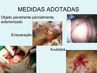 MEDIDAS ADOTADAS 
Objeto penetrante parcialmente 
exteriorizado 
Evisceração 
Avulsões 
 