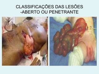 CLASSIFICAÇÕES DAS LESÕES 
-ABERTO OU PENETRANTE 
 