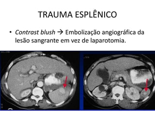 • Contrast blush  Embolização angiográfica da
lesão sangrante em vez de laparotomia.
TRAUMA ESPLÊNICO
 