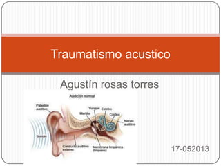 Agustín rosas torres
17-052013
Traumatismo acustico
 
