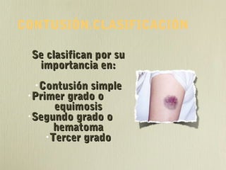 CONTUSIÓN.CLASIFICACIÓN
Se clasifican por suSe clasifican por su
importancia en:importancia en:
•Contusión simpleContusión simple
•Primer grado oPrimer grado o
equimosisequimosis
•Segundo grado oSegundo grado o
hematomahematoma
•Tercer gradoTercer grado
 