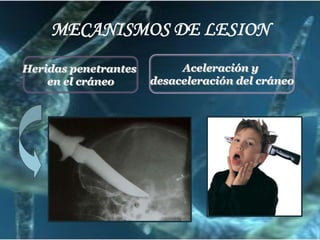 MECANISMOS DE LESION
Heridas penetrantes
en el cráneo

Aceleración y
desaceleración del cráneo

 