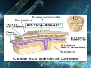 HEMATOMA SUBGALEAL

 