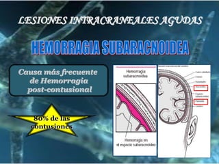 LESIONES INTRACRANEALES AGUDAS

Causa más frecuente
de Hemorragia
post-contusional

80% de las
contusiones

 