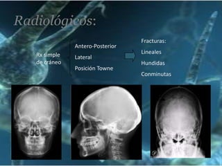 Radiológicos:
Antero-Posterior
Rx simple
de cráneo

Lateral
Posición Towne

Fracturas:
Lineales
Hundidas
Conminutas

 