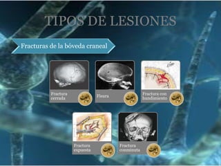 Sensación de desvanecimiento , cambios en el estado de alerta (somnolencia, estupor, coma superficial y coma profundo).