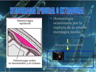 Hemiparesia/Hemiplejia