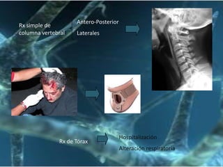 Síndrome postcontucionalPosterior semanas o mesesCefalea  de inicio bruscoPulsatil, mareosCansaciofacil, insomnioEstudios normalesTest neuropsicológicos
