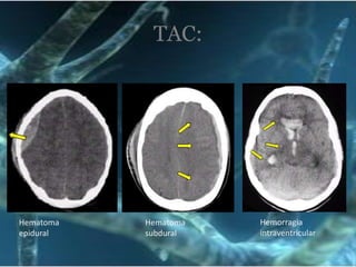 Absceso cerebralA través de la fistulaBacterias englobadas con material purulentoTxQx