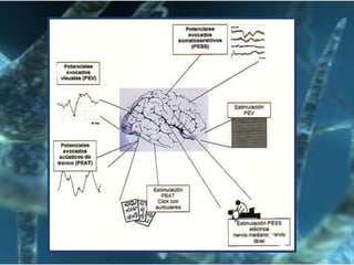 Hemiparesia o hemiplejiaPor edemaDisminución de la movilidad de la mitad contralateral del cuerpo