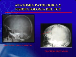 ANATOMIA PATOLOGICA Y FISIOPATOLOGIA DEL TCE FRACTURA LINEAL PARIETAL FRACTURA DIASTAZADA 